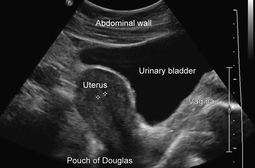 Transabdominal ultrasound of the uterus. Note the urinary ...