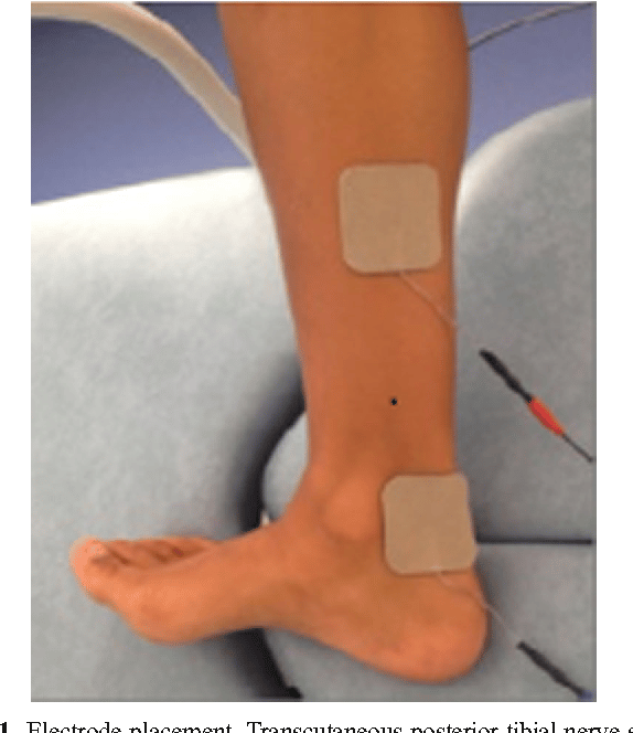 Transcutaneous posterior tibial nerve stimulation: evaluation of a ...