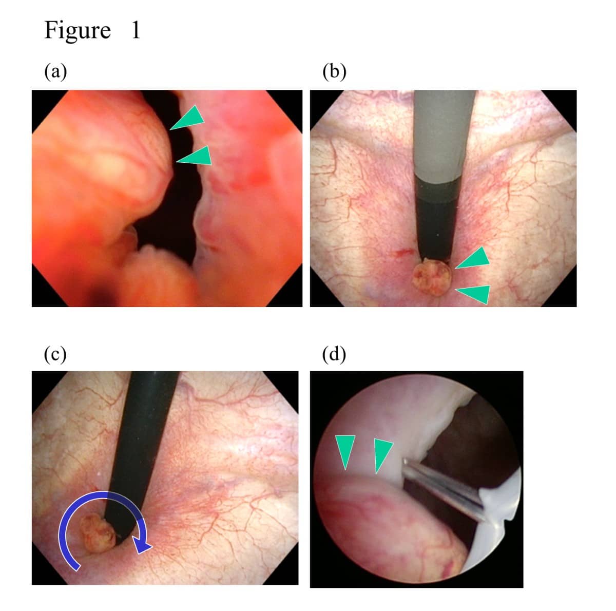 Transurethral marking incision of the bladder neck: a helpful technique ...
