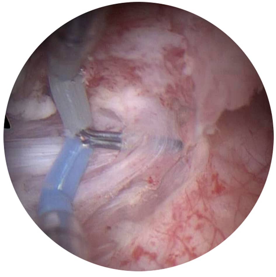Transurethral Needle Electrode Resection of Bladder Tumor: A Technique ...