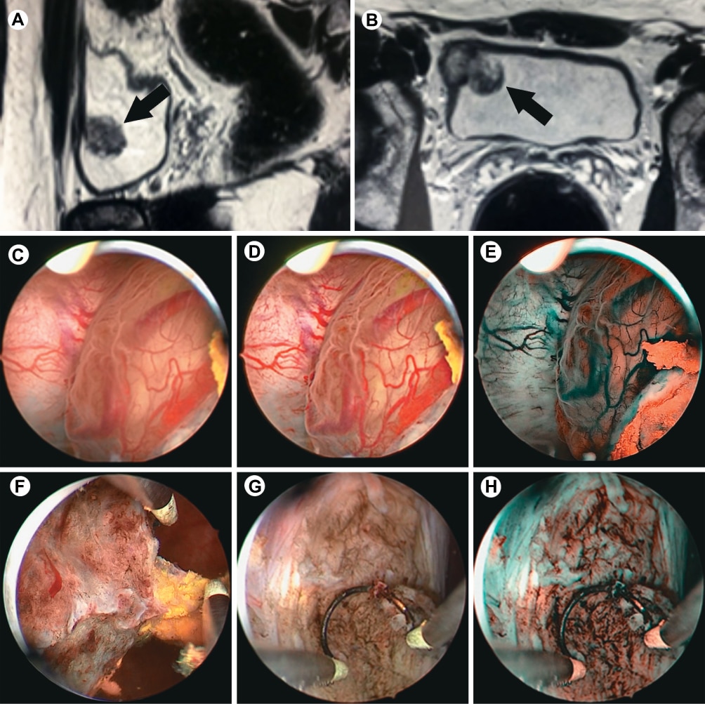 Transurethral resection of a large bladder hemangioma of mixed histolo ...