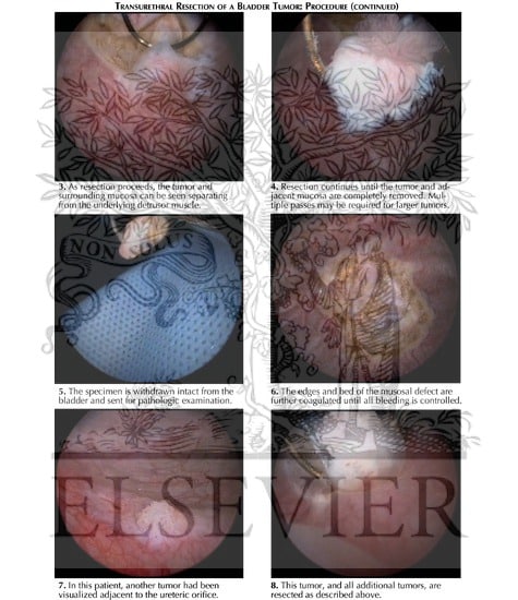 Transurethral Resection of Bladder Tumor: Procedure (Continued)