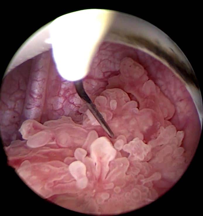 Transurethral resection of bladder tumors