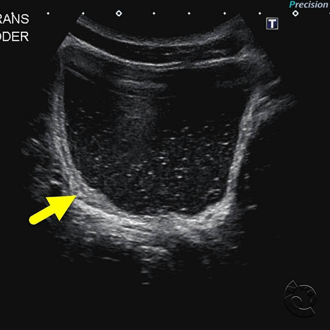 Transverse ultrasound of the urinary bladder in a patient with ...