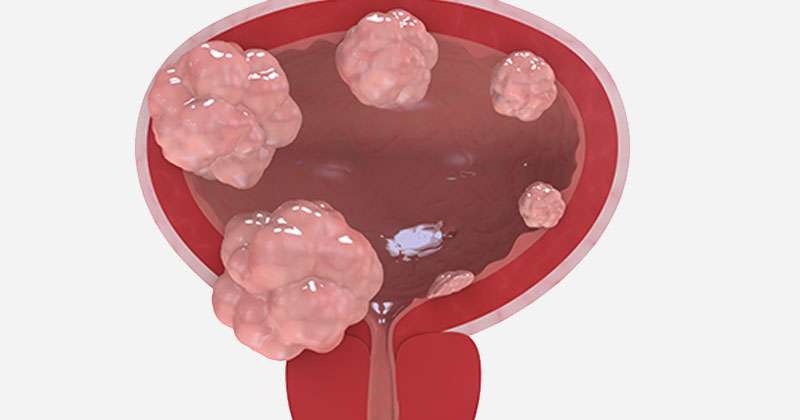 Treatment for Bladder Cancer: What patients Need to Understand