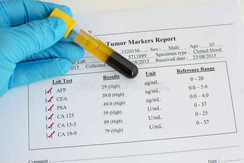 Tumor marker results stock photo. Image of exam ...
