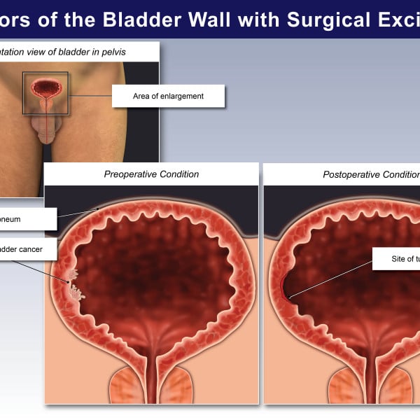 Tumors of the Bladder Wall with Surgical Excision
