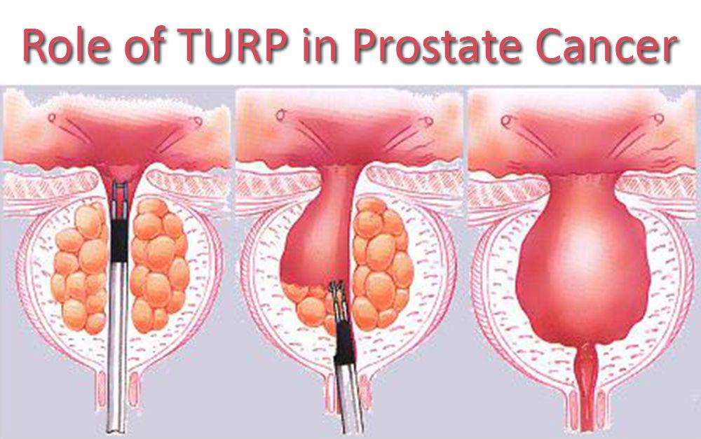TURP Treatment in India for Prostate cancer