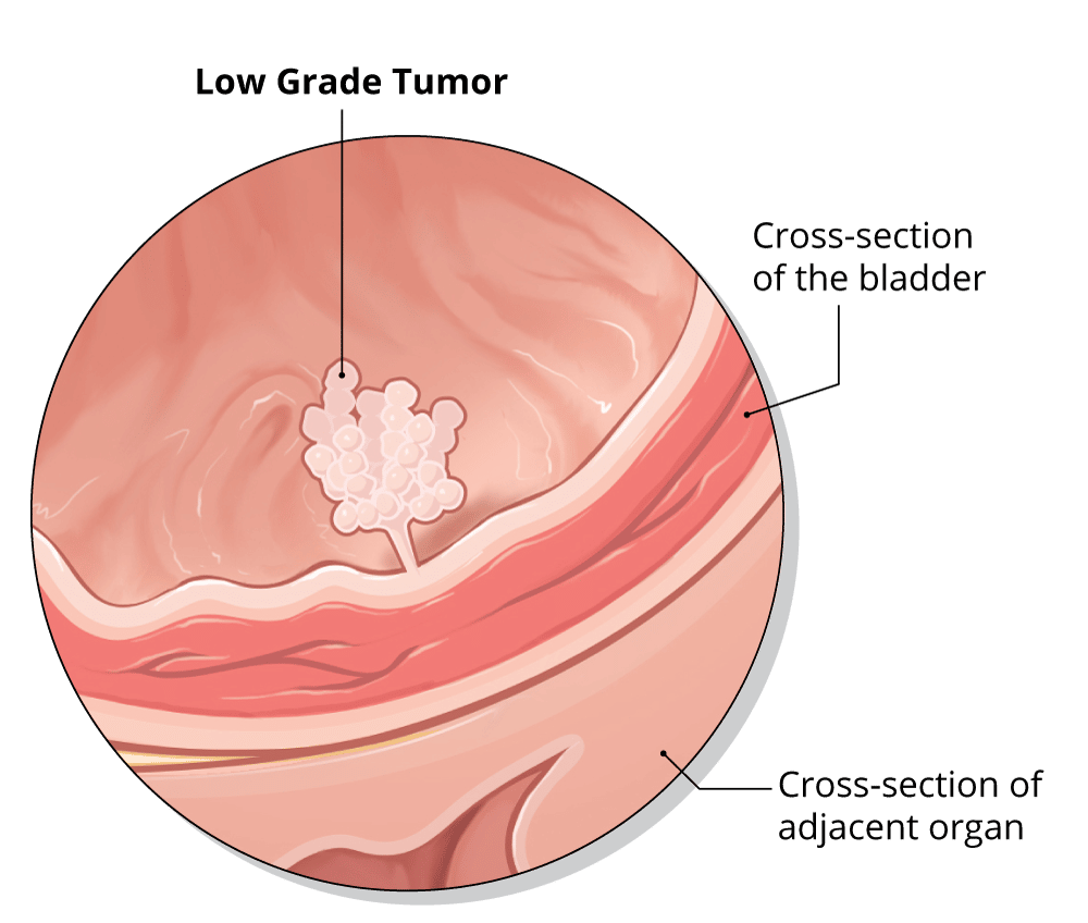 Types of Bladder Cancer