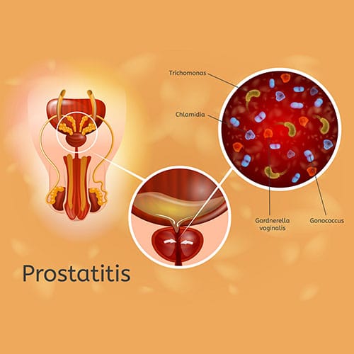 Types of Prostate Disease: Causes and Symptoms