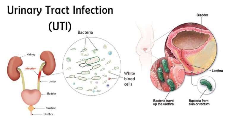 Types of Urinary Tract Infections