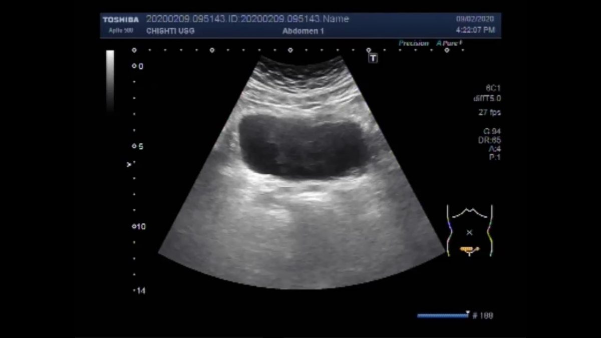 Ultrasound Video showing a large vesical growth in the urinary bladder ...