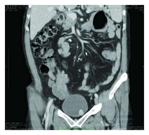 Unexpected Small Urinary Bladder Pheochromocytoma: A Nonspecific ...