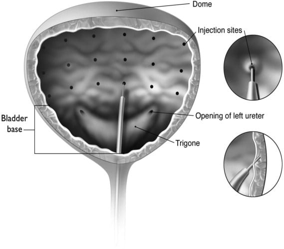 Updated: BOTOX for neurogenic bladder and prevention of autonomic ...