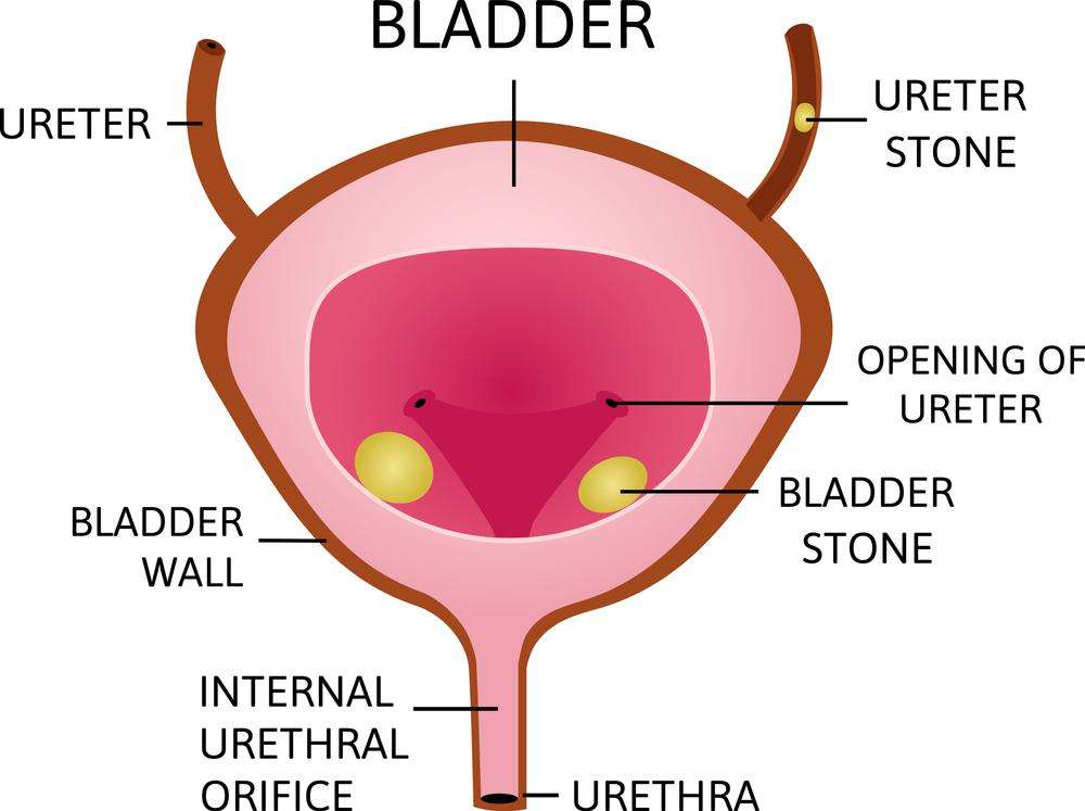 Urinary Bladder Stone Treatment in Pune