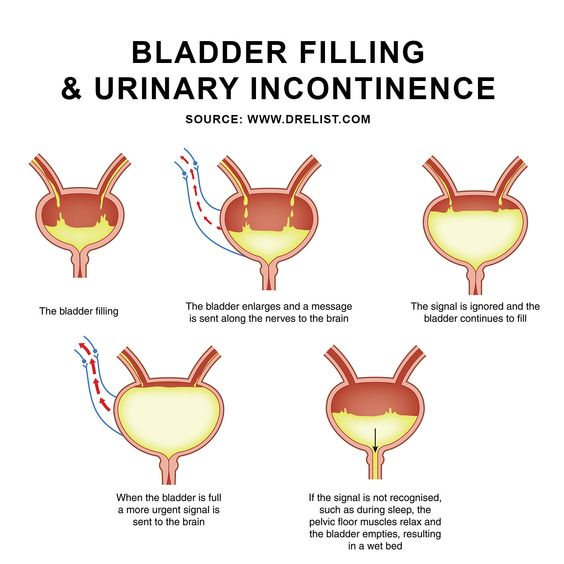 Urinary Incontinence Image
