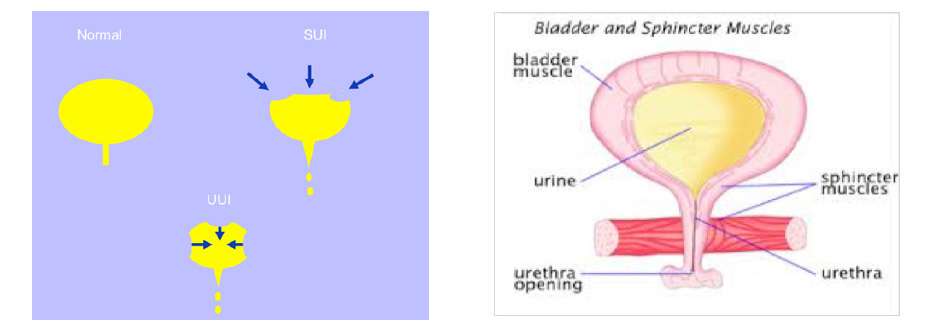 Urinary Incontinence in Women