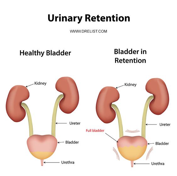 Urinary retention is a condition in which the bladder is unable to ...