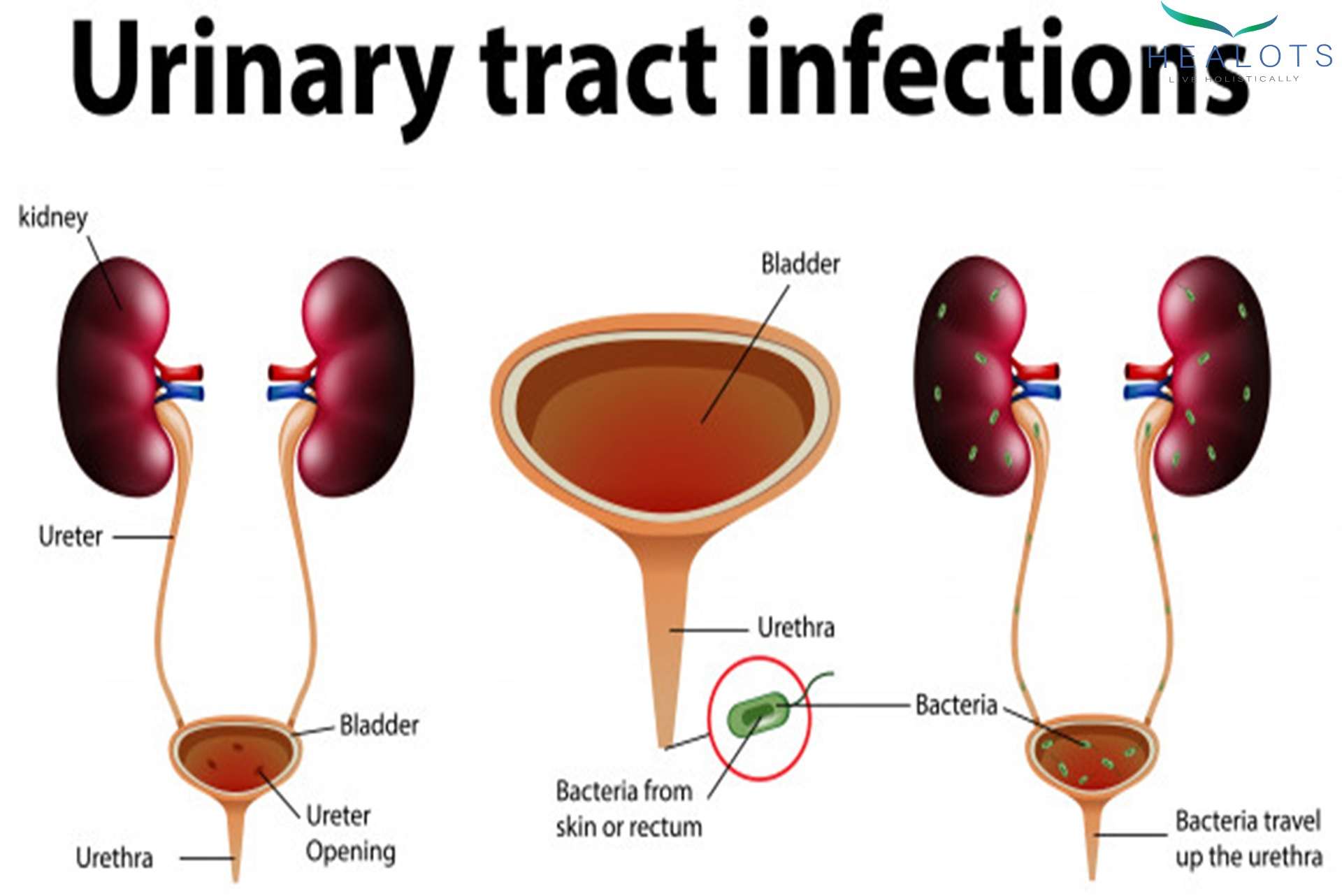 Urinary tract infection â should have been concerned ...