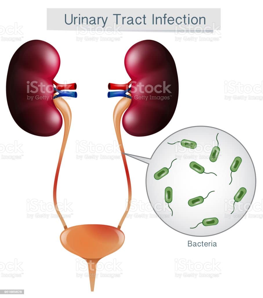 Urinary Tract Infection On White Background Stock Illustration ...