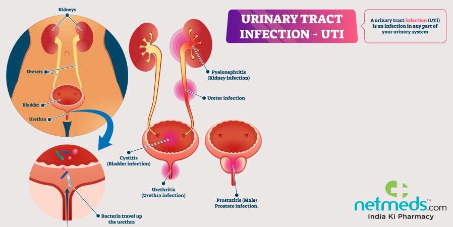 Urinary Tract Infection (UTI): Causes, Symptoms, and Treatment ...