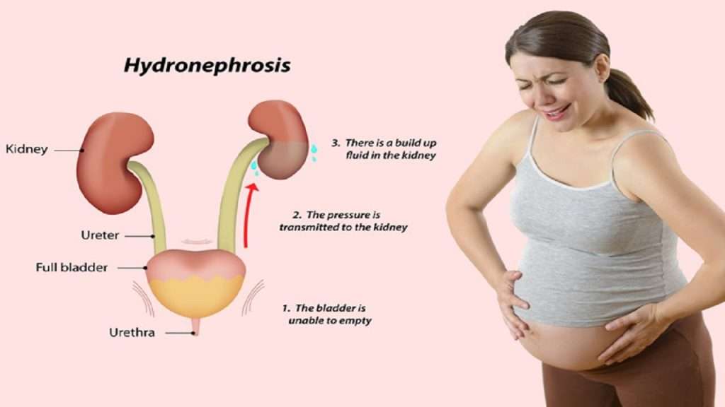 Urinary Tract Infection (UTI) In Pregnancy: Symptoms &  Treatment ...