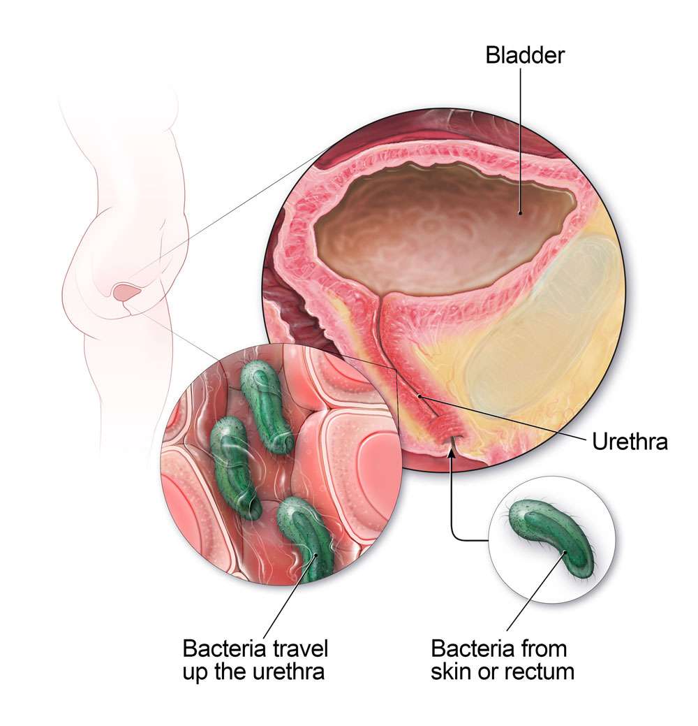 Urinary Tract Infection (UTI) Signs, Remedies &  Symptoms