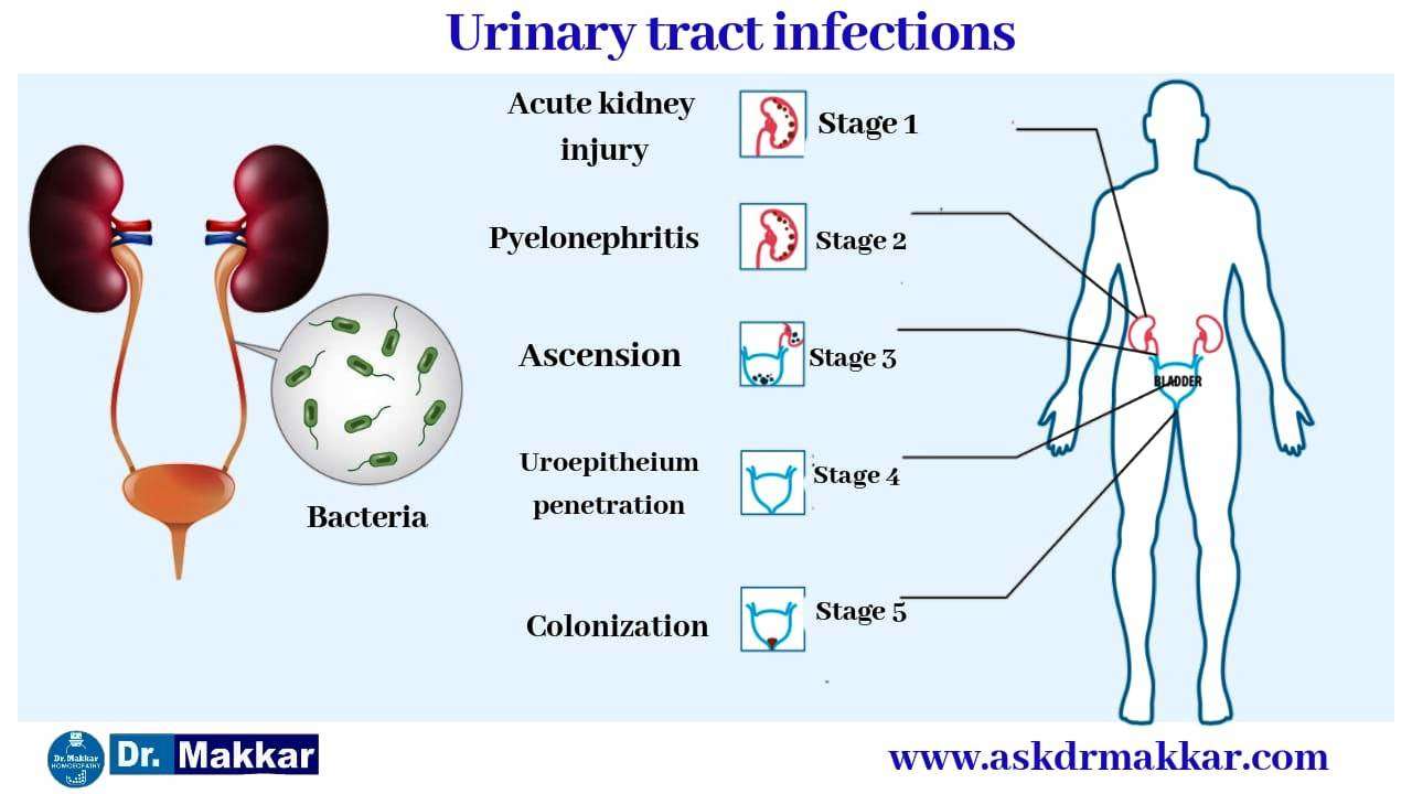 Urinary tract infection UTI Treatment using homeopathy with excellent ...