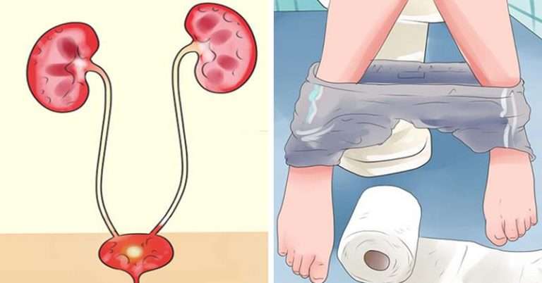 Urinary Tract Infections: Causes, Symptoms &  Best Treatments