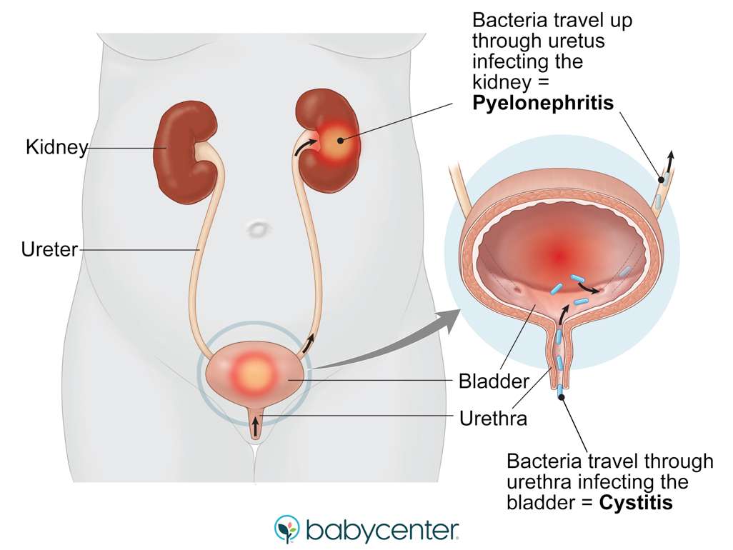 Urinary tract infections during pregnancy