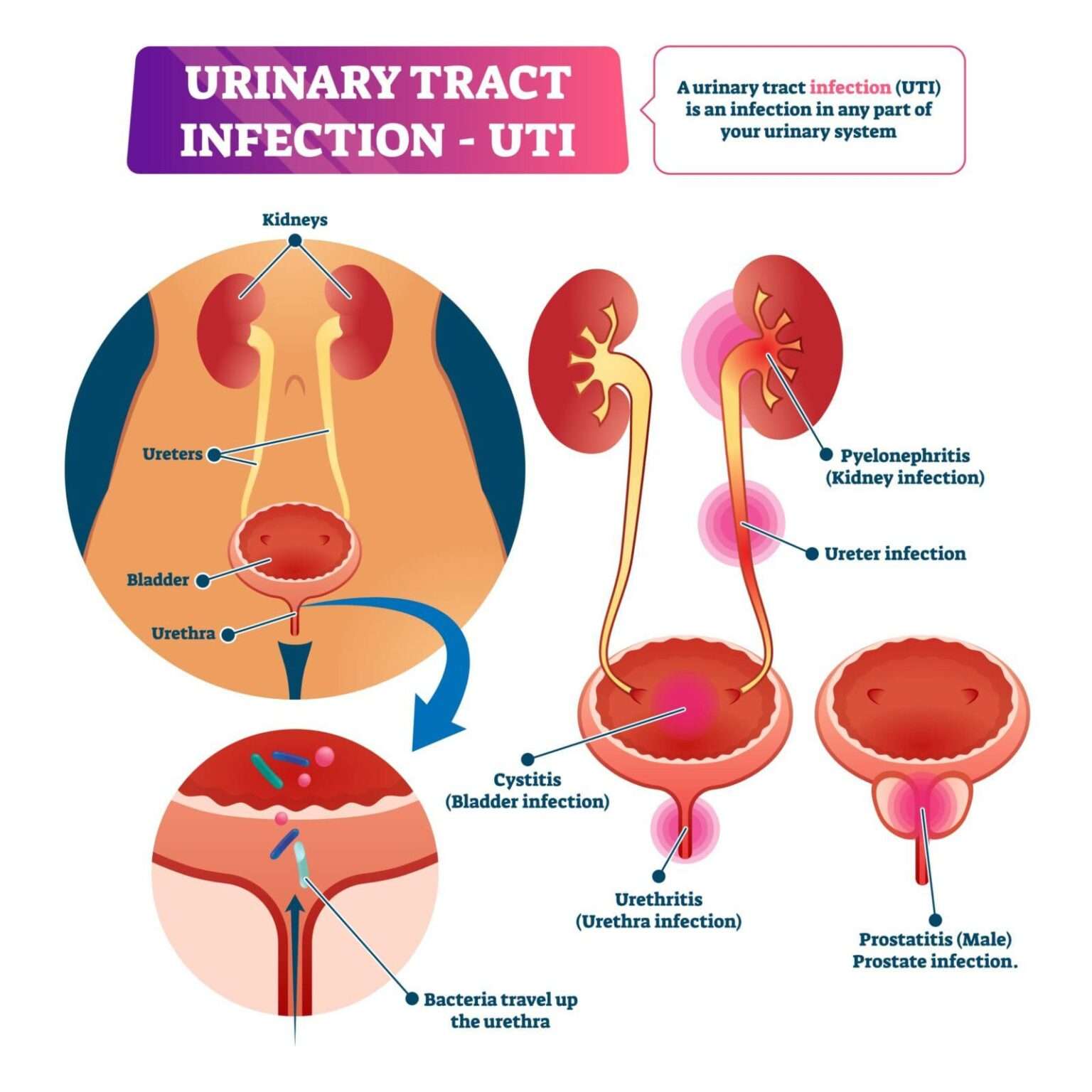 Urinary Tract Infections / Emed Primary Care Clinic ...