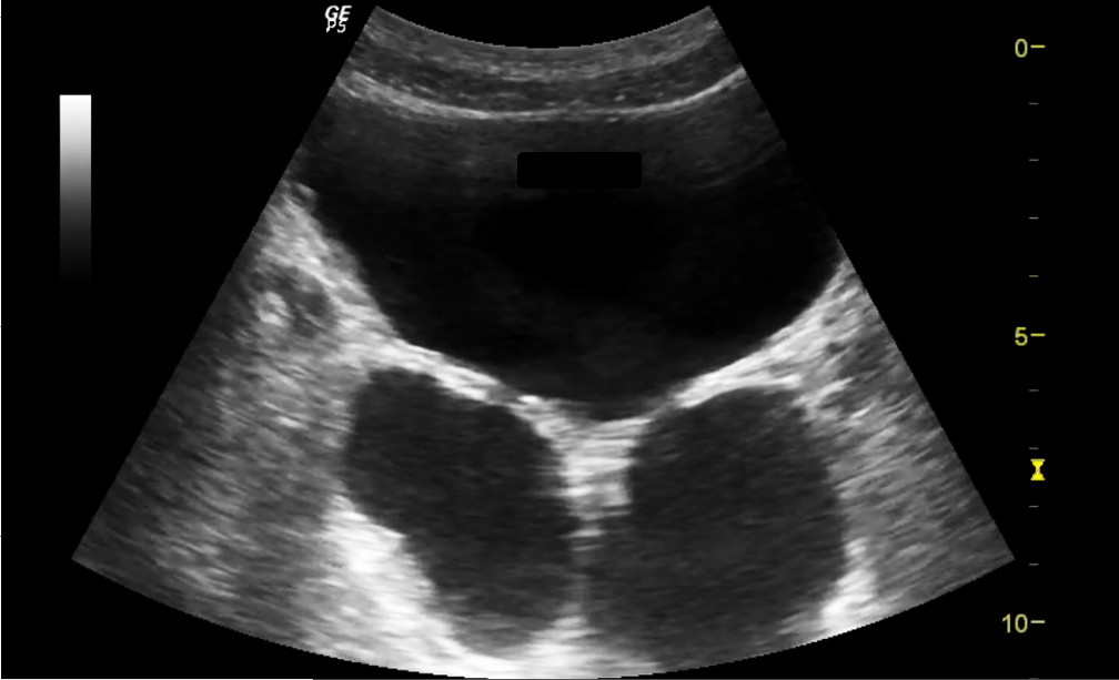 Using Point of Care Ultrasound for Bladder Diagnosis