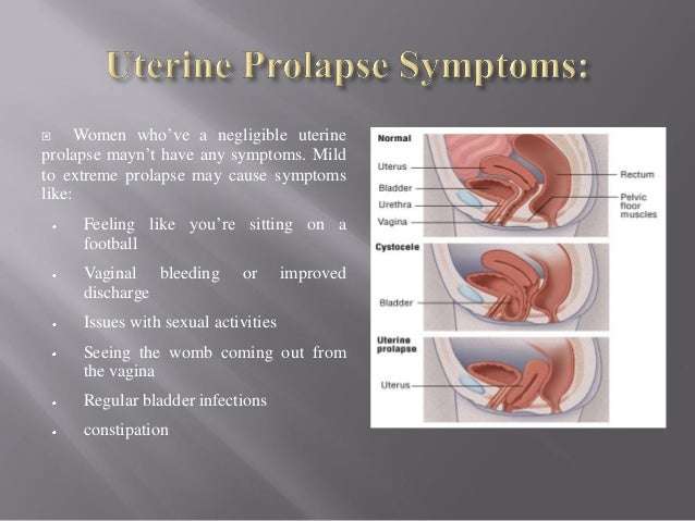 Uterine Prolapse  Symptoms and Diagnosis