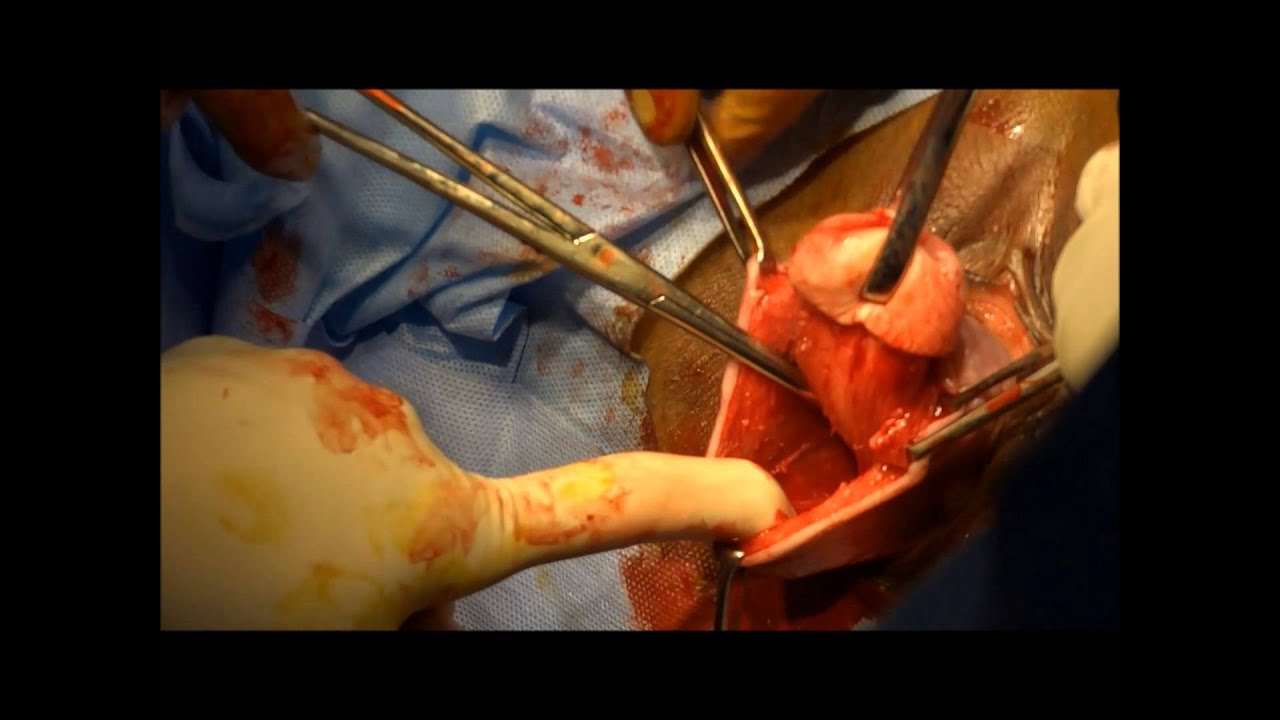 Vaginal Hysterectomy for prolapse uterus