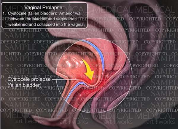 Vaginal Prolapse