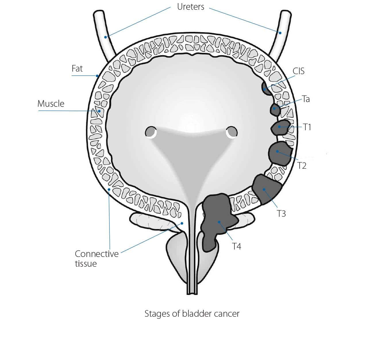 What are the grades and stages of bladder cancer?