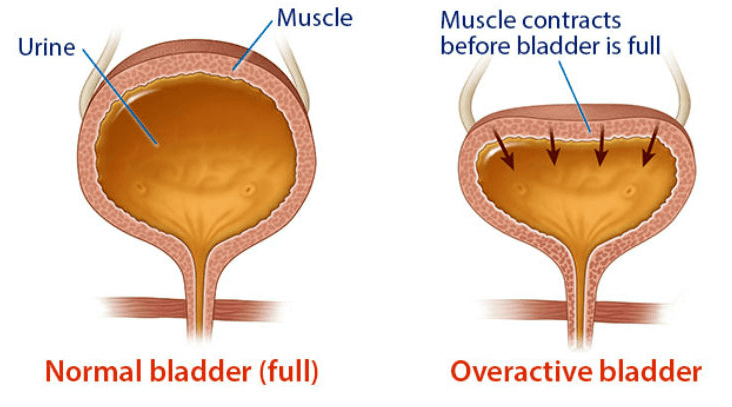 What are the signs that I have an overactive bladder?