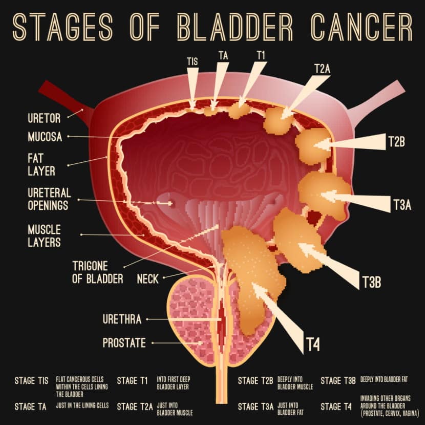 What Are The Symptoms Of Bladder Cancer In Woman