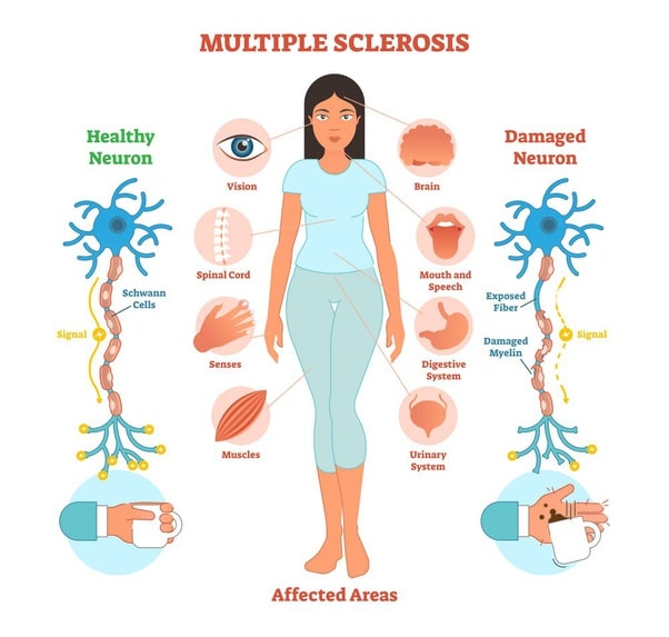 What are the symptoms of multiple sclerosis?