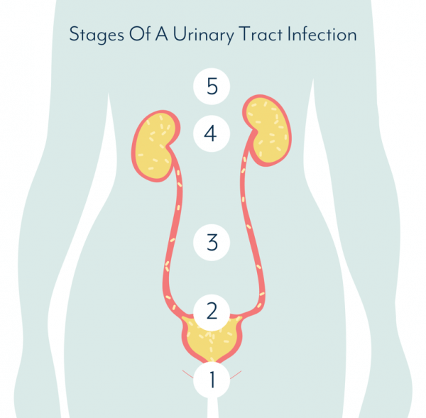 What Causes A Urinary Tract Infection And How Do You Get Rid Of A UTI?