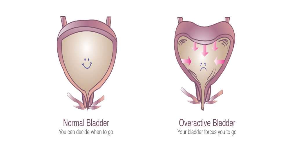 What causes an overactive bladder and what you can do to stop it ...