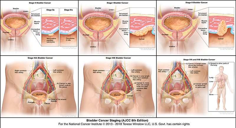 What Causes Bladder Cancer In Females : Bladder Cancer ...