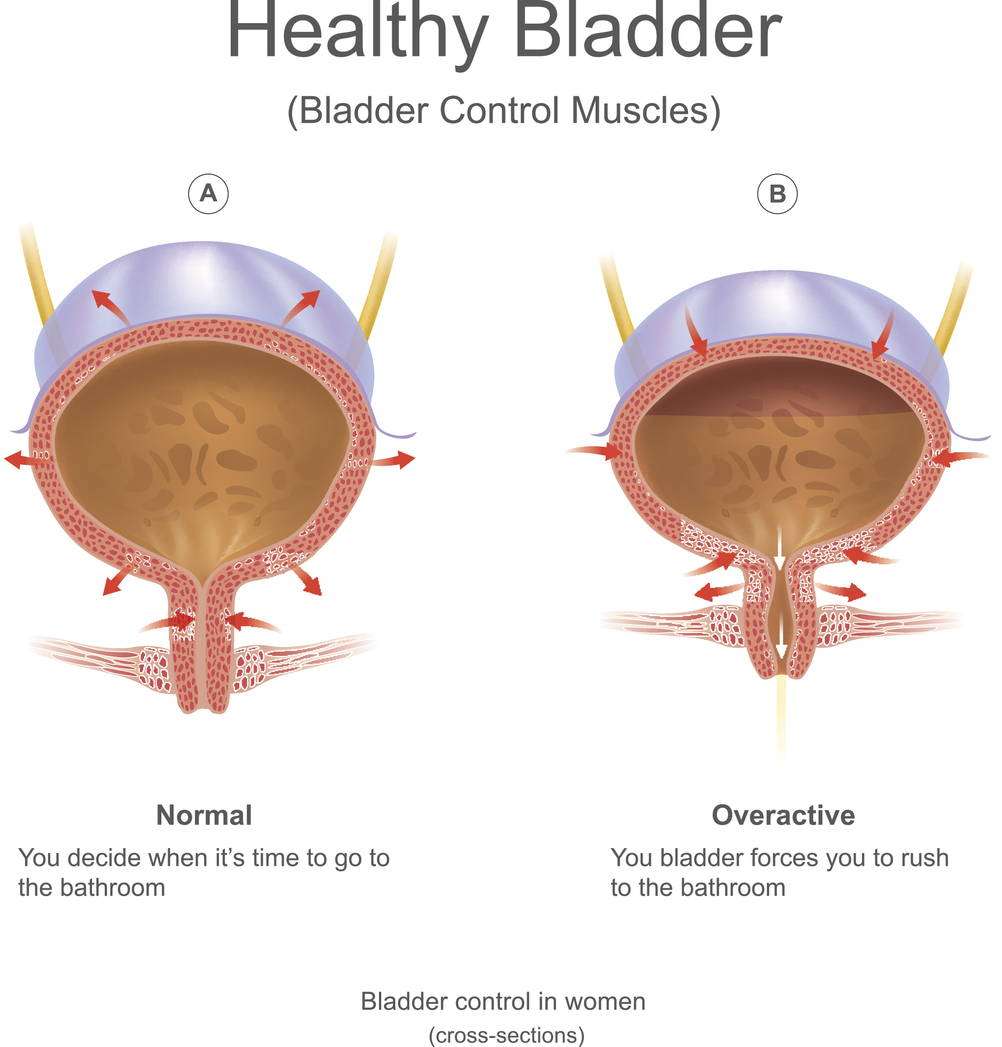 What Causes Bladder Leakage? Types &  Causes of Urinary Incontinence â Proof