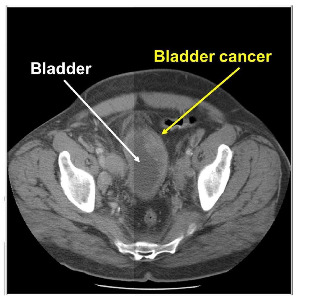 What Does Bladder Cancer Look Like On Ct Scan