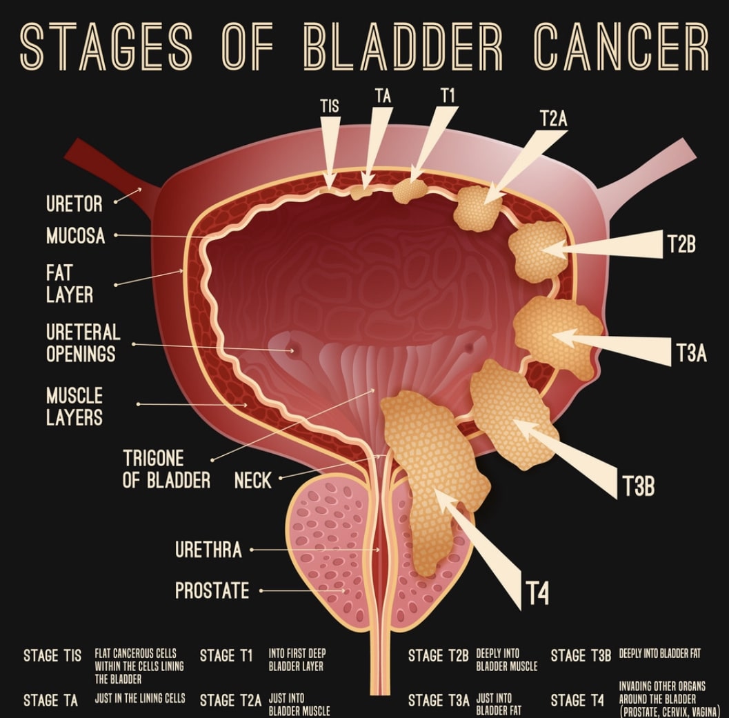 what is metastatic bladder cancer ï¸? Updated Guide 2022