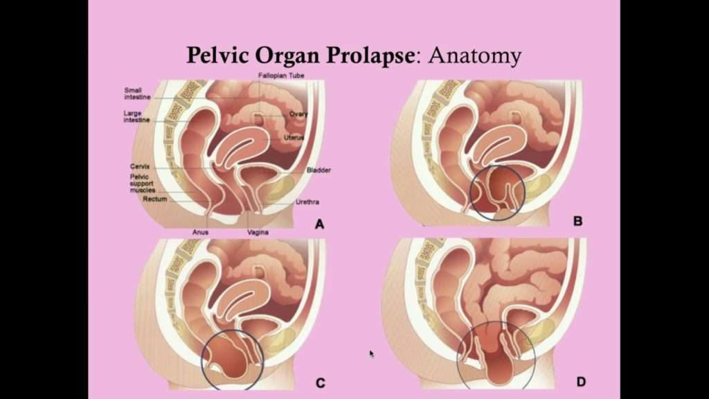 What Is Pelvic Organ Prolapse?