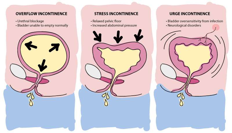 What is the Most Common Cause for Urge Incontinence?