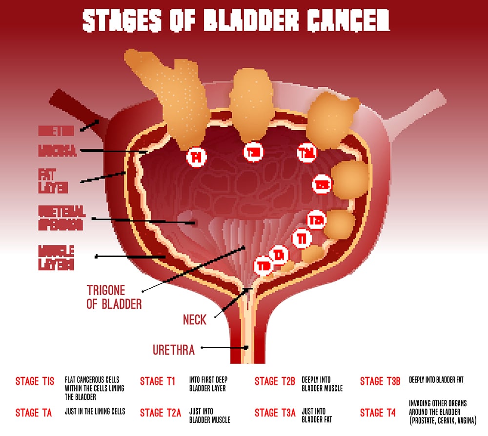 what stage is muscle invasive bladder cancer ï¸? Updated Guide 2022